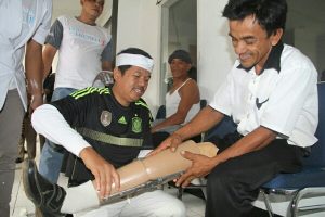 50 Pasang Kaki Palsu untuk Pasien Disabilitas Purwakarta